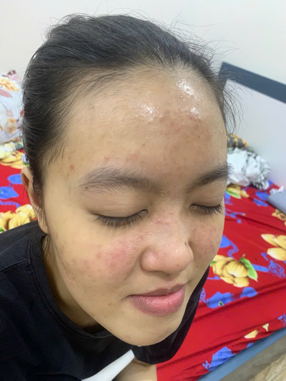 Khách hàng Minh Nguyệt khi đang bị mụn