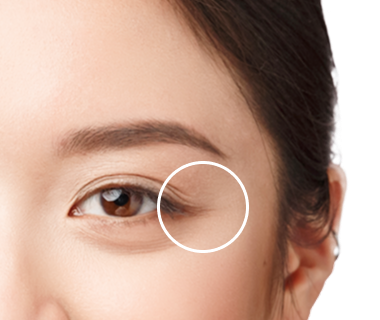 Cấy mỡ cải thiện rãnh lệ