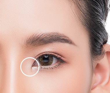 Mở góc mắt trong