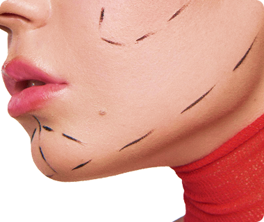 Phẫu thuật độn cằm