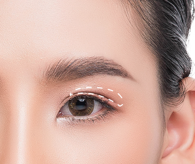 Cắt da thừa mi trên qua đường nếp mí